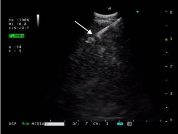 Projekt badawczy polskich specjalistów – Endosonografia z igłami rdzeniowymi o średnicy 25.